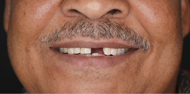 implant kopya implant kopya