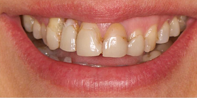 pembeestetikzirkonyum